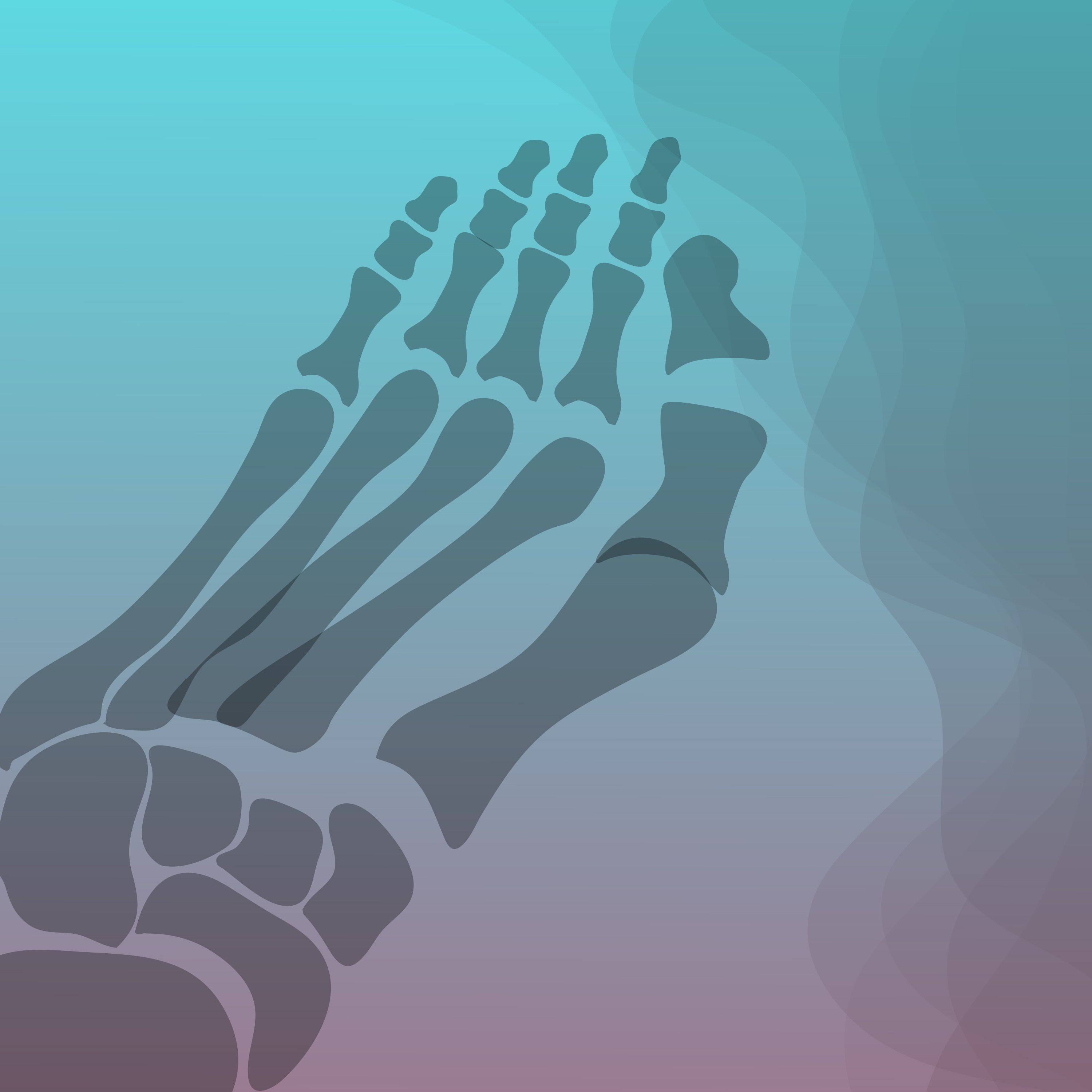 Metatarsal Bone Fractures and a Rare Bone Disease Hiding in Plain Site