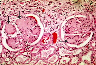 Diabetic Nephropathy (Re-release)