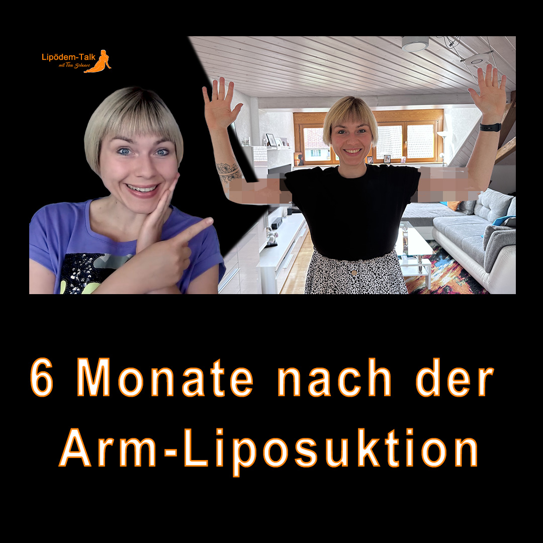 6 Monate nach Arm-Liposuktion inkl. Hautstraffung - Stand aktuell