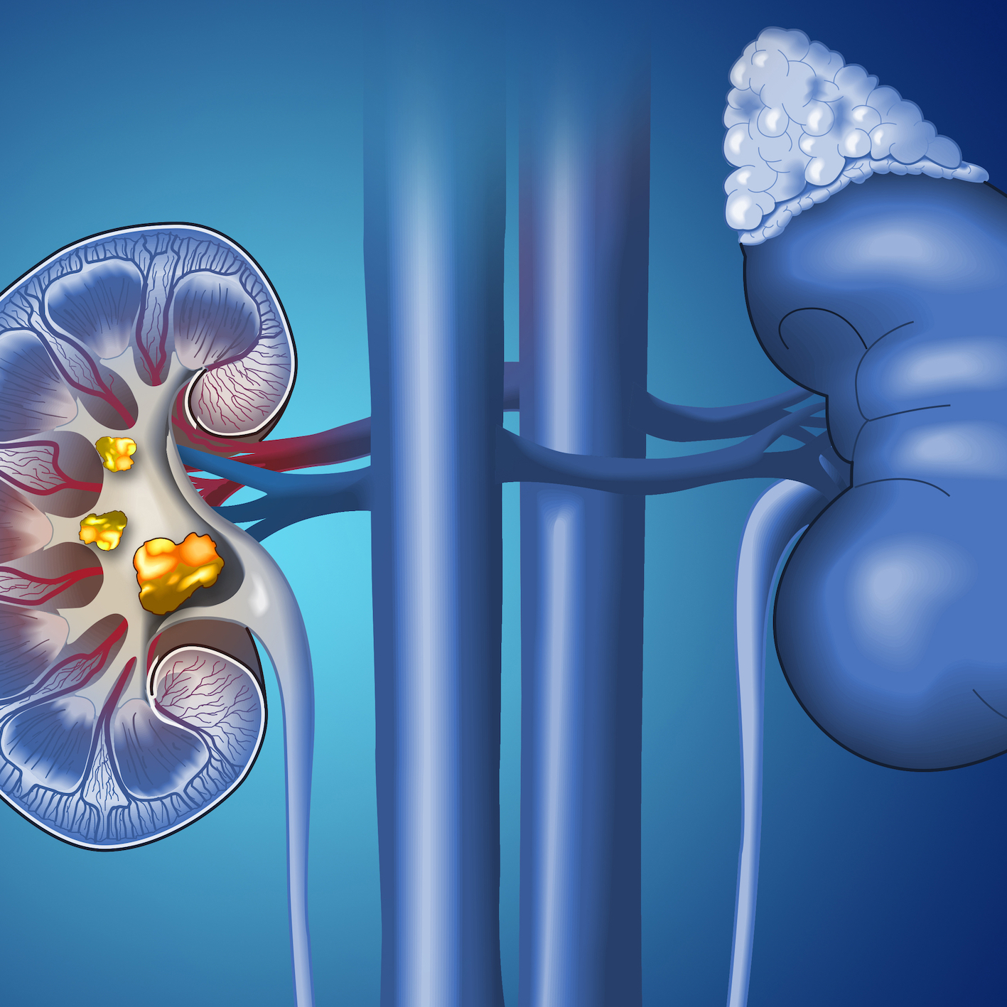 Kidney Stones. Diagnosis, Treatment and Prevention