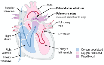 Patent Ductus Arteriosis (Re-release)