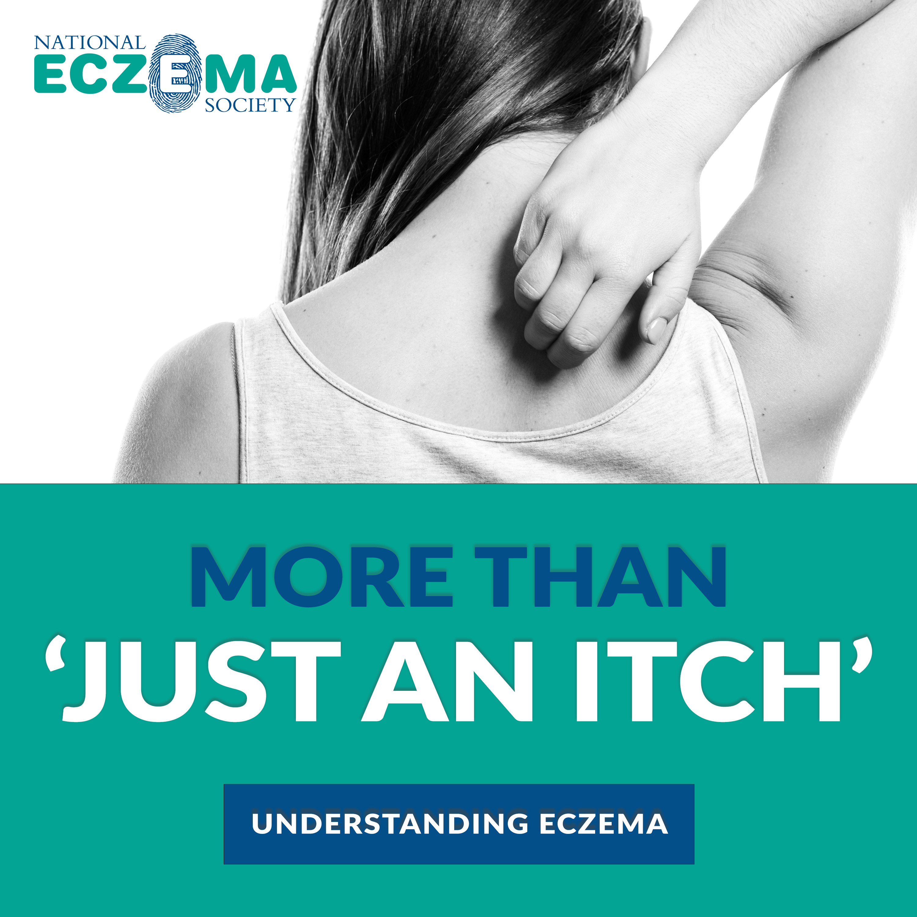 ⁣Living With Eczema