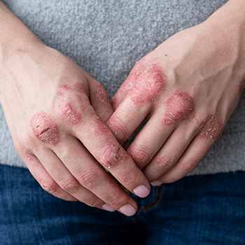 ⁣Managing Your Patients with Psoriasis and IBD: A Conversation with the Experts