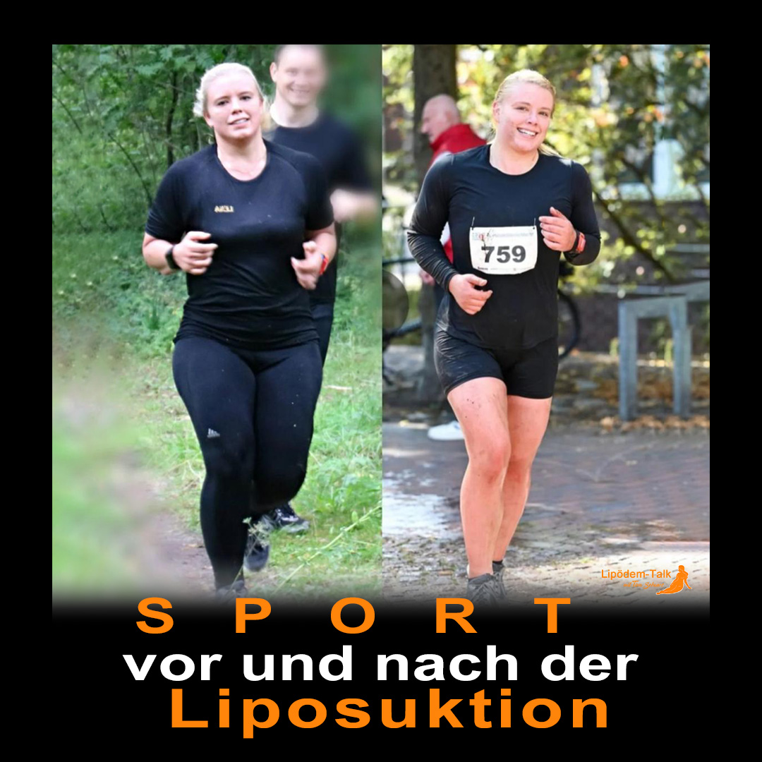 Sport vor und nach der Liposuktion